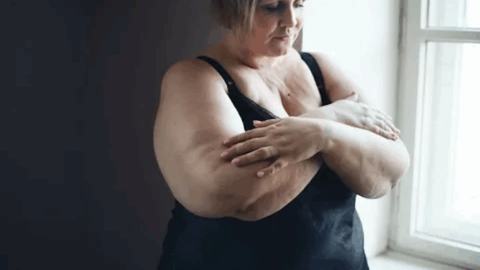 Study says breast cancer is caused by obesity.