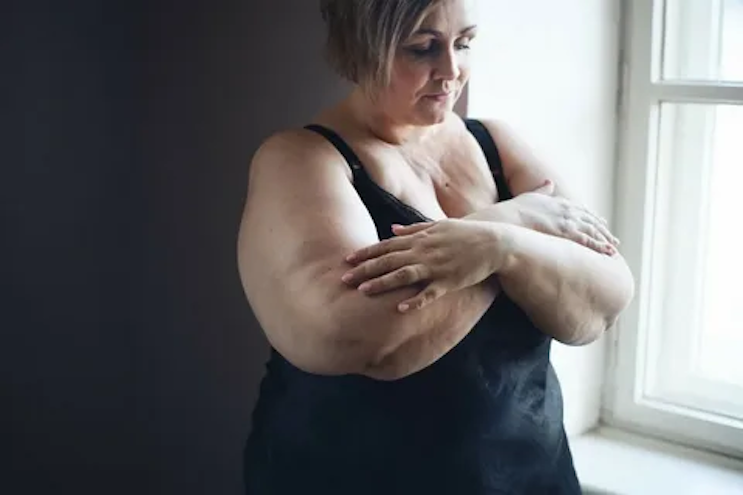 British Study Confirms Breast Cancer Is Caused by Obesity