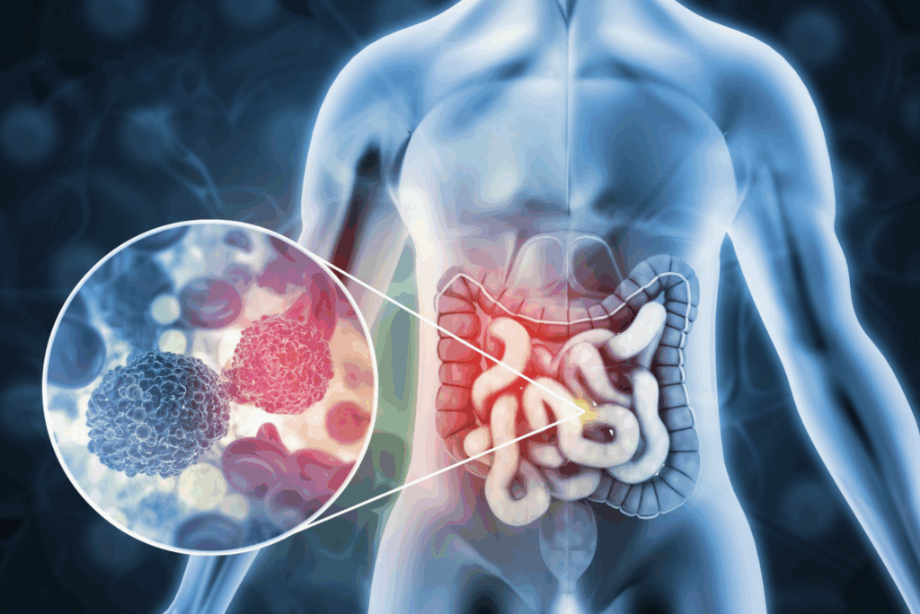 VAERS Data Reveals 8,300% Explosion in Colon Cancer Reports Since mRNA Vaccine Rollout